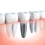 DENTAL IMPLANTS. Click to find out more.